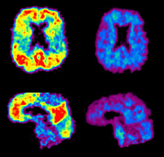 Two brain scans on the left show bright red and yellow areas on a blue brain, both from a top view (top) and side view (bottom). Two brain scans on the right show blue brains without red and yellow.